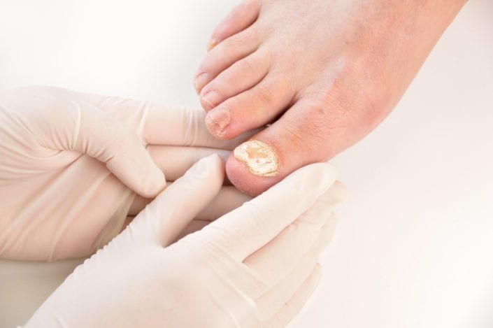 Чем опасен грибок ногтей? Причины появления, лечение и профилактика грибка ногтей на ногах здоровье, Здоровье