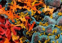 Severe Infections Linked to Increased Dementia Risk