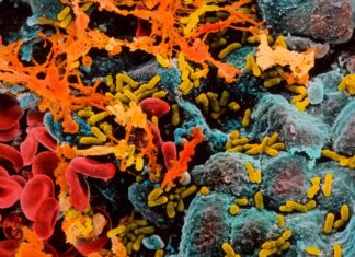 Severe Infections Linked to Increased Dementia Risk