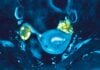 The “Evening Star” Phenomenon: How PCOS May Delay Menopause and Boost Late-Life Fertility