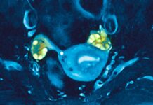 The “Evening Star” Phenomenon: How PCOS May Delay Menopause and Boost Late-Life Fertility