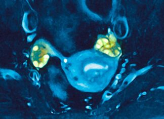 The “Evening Star” Phenomenon: How PCOS May Delay Menopause and Boost Late-Life Fertility
