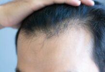 Why GLP-1 Drugs Like Ozempic May Be Causing Hair Loss: A New Study Explains