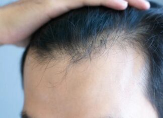 Por que medicamentos GLP-1 como o Ozempic podem estar causando queda de cabelo: um novo estudo explica